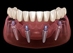 Dental Implantology