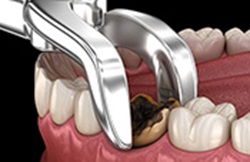 Difficult Tooth Extraction