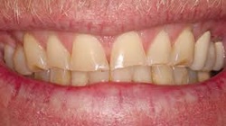 Full Mouth Rehabilitation